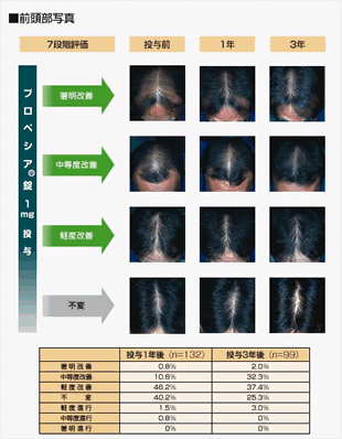 プロペシア3年実例写真(前頭部写真)