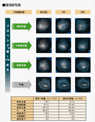 プロペシア3年実例写真(頭頂上部写真)